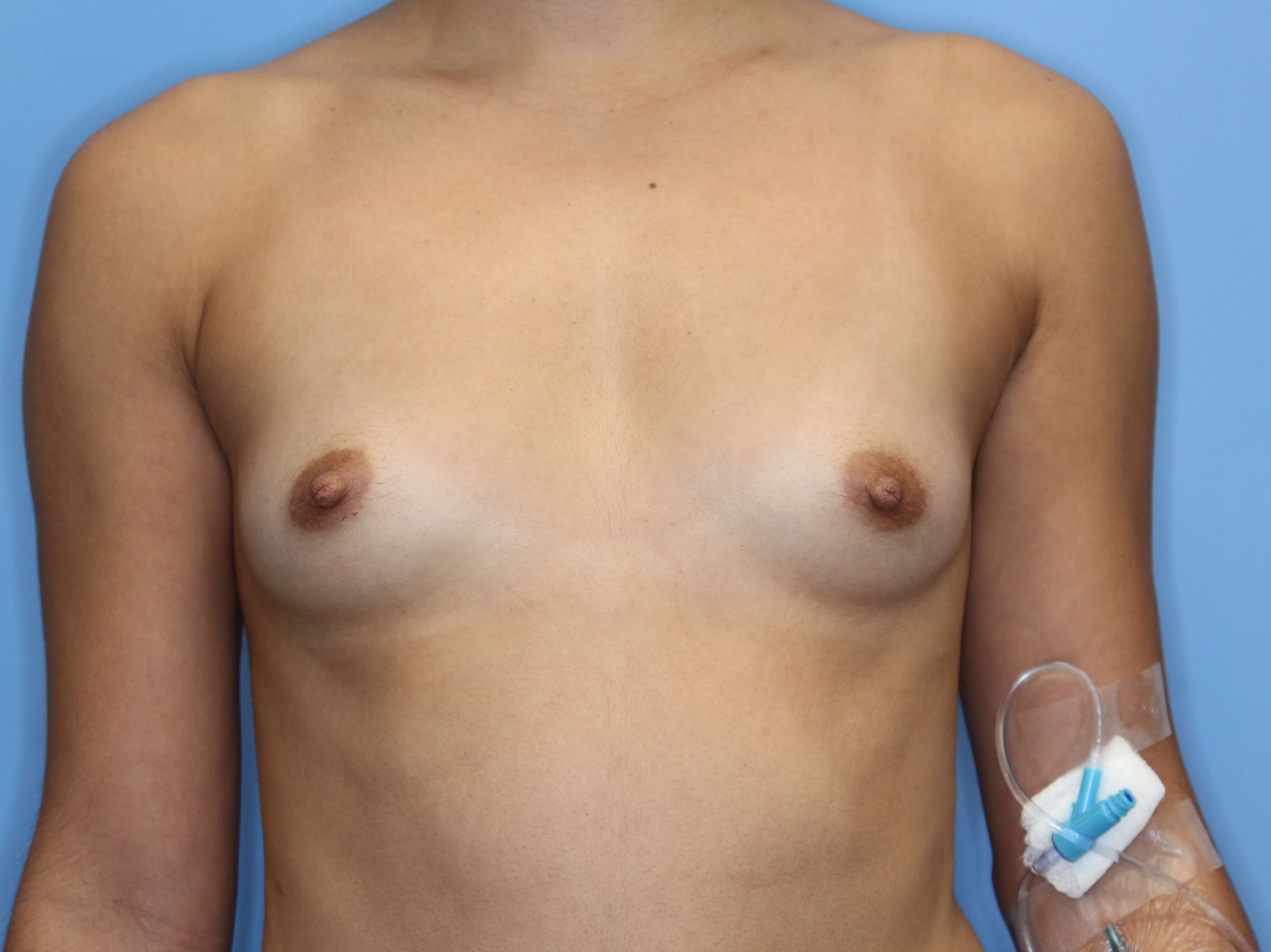 Silicone Implants 280 cc Before