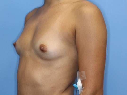 Silicone Implants 280 cc Before