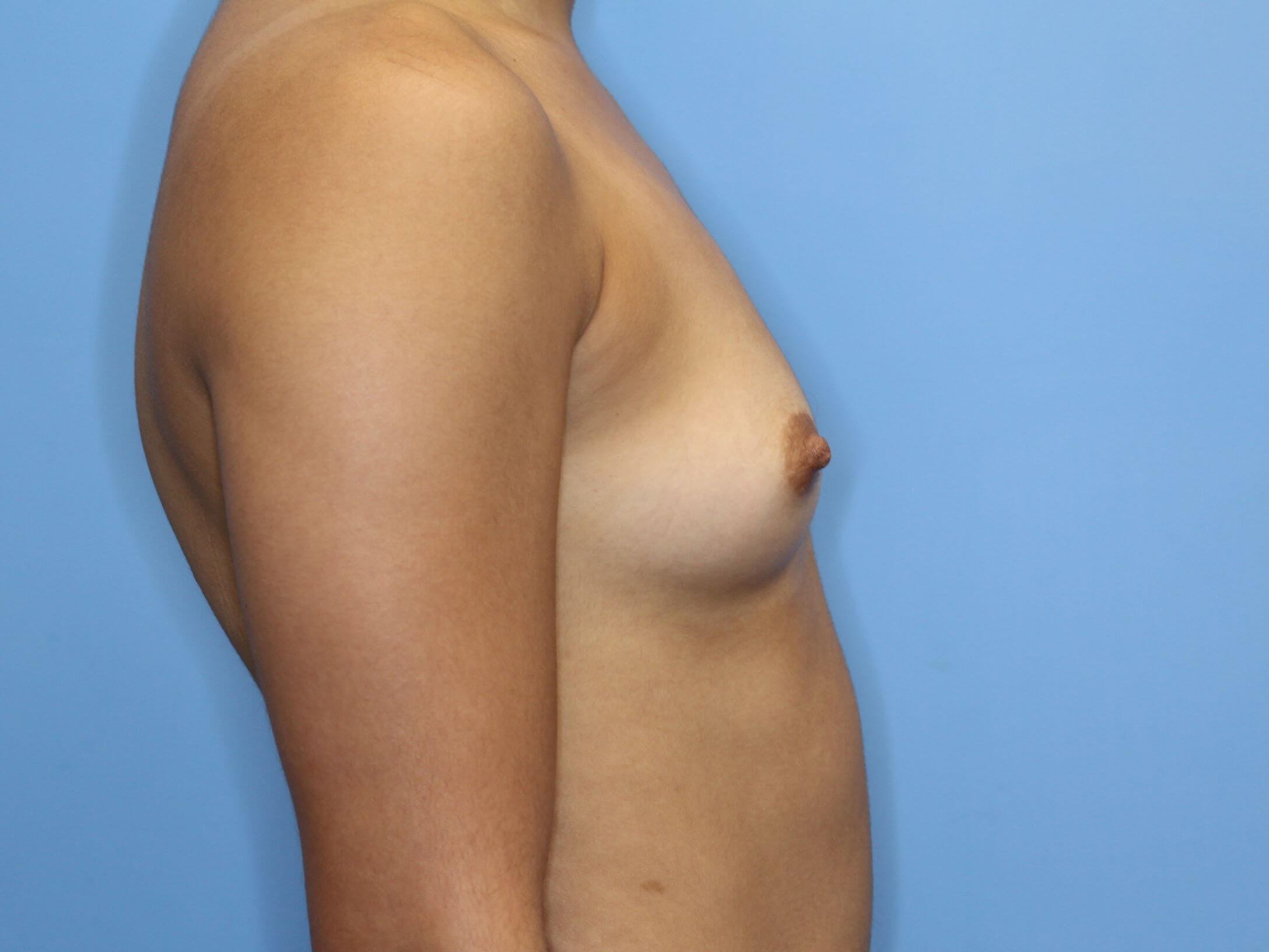 Silicone Implants 280 cc Before