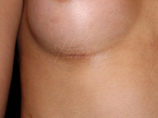 3 cm Scars 2 months post op Before