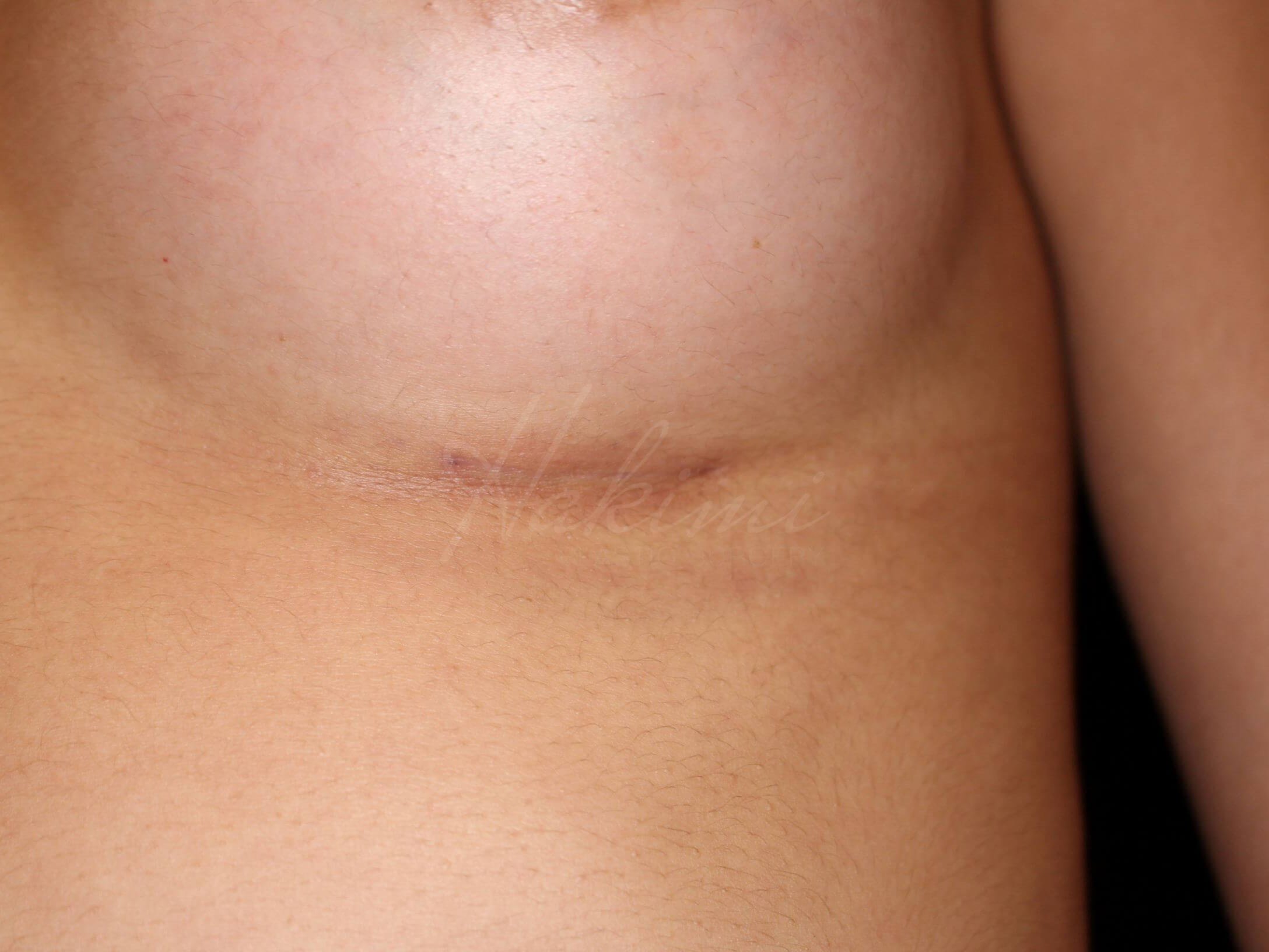 3 cm Scars 2 months post op After