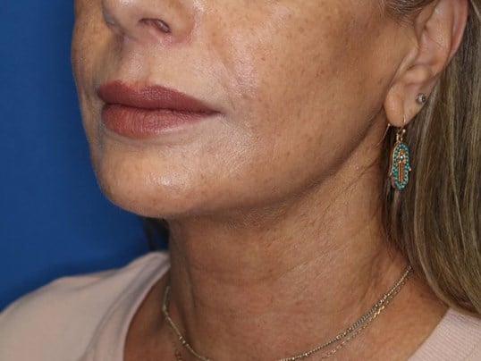 Nonsurgical Skin Tightening After