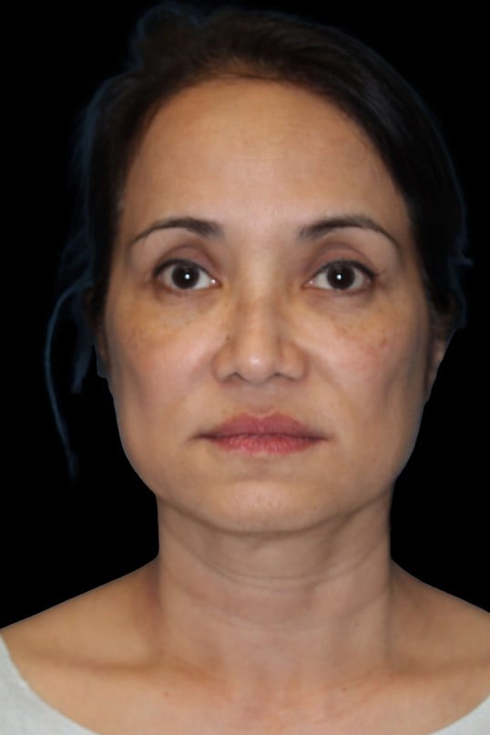 Facelift and Fat Injection Before