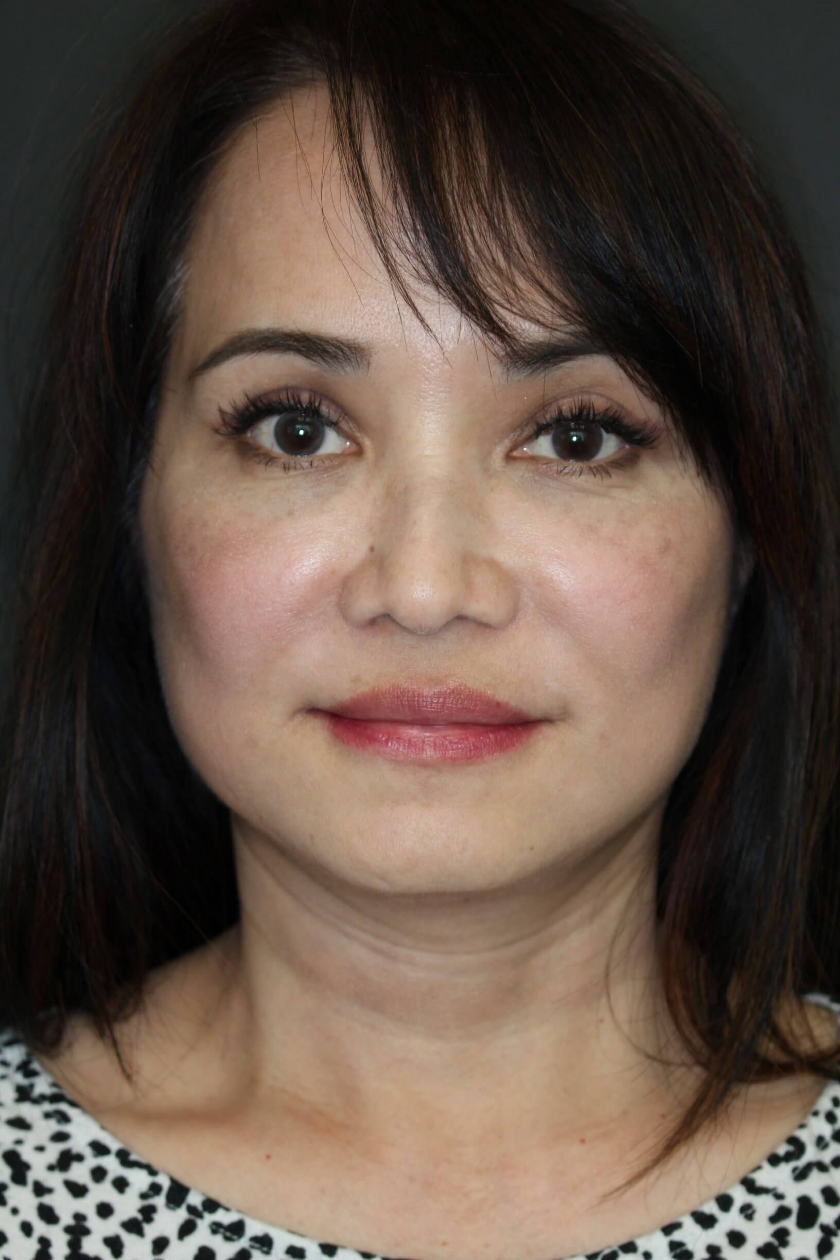 Facelift and Fat Injection After