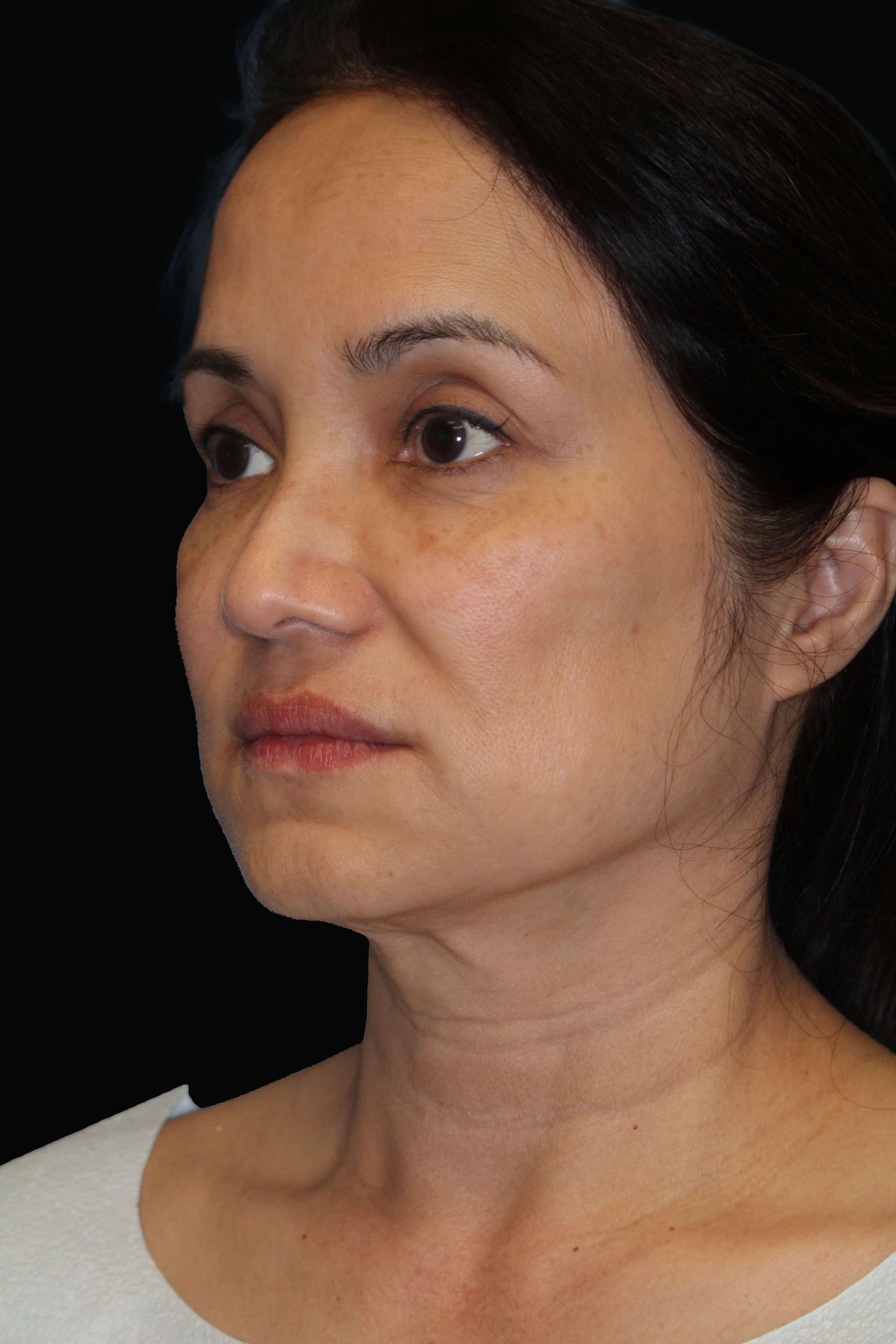 Facelift and Fat Injection Before
