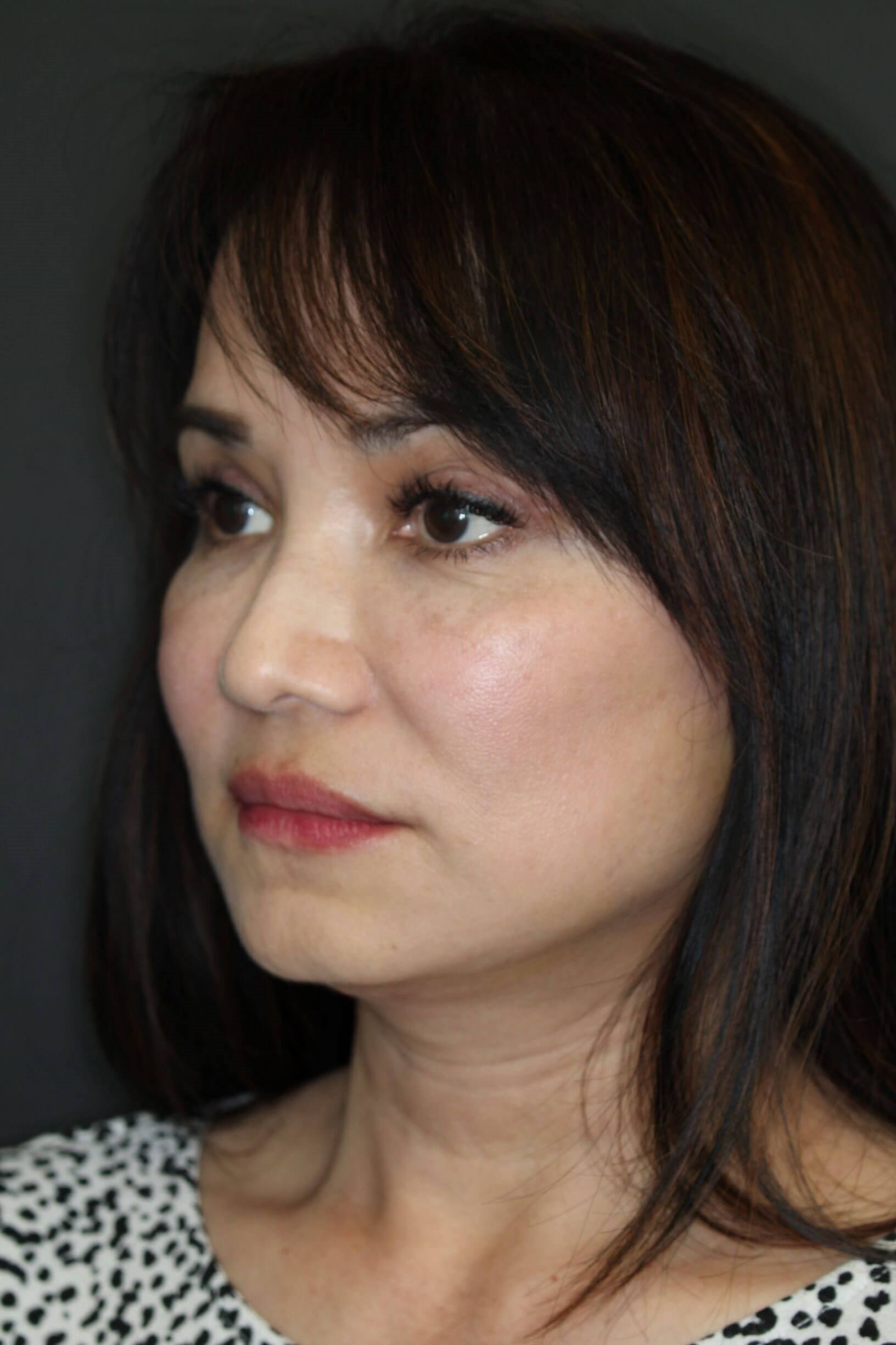 Facelift and Fat Injection After