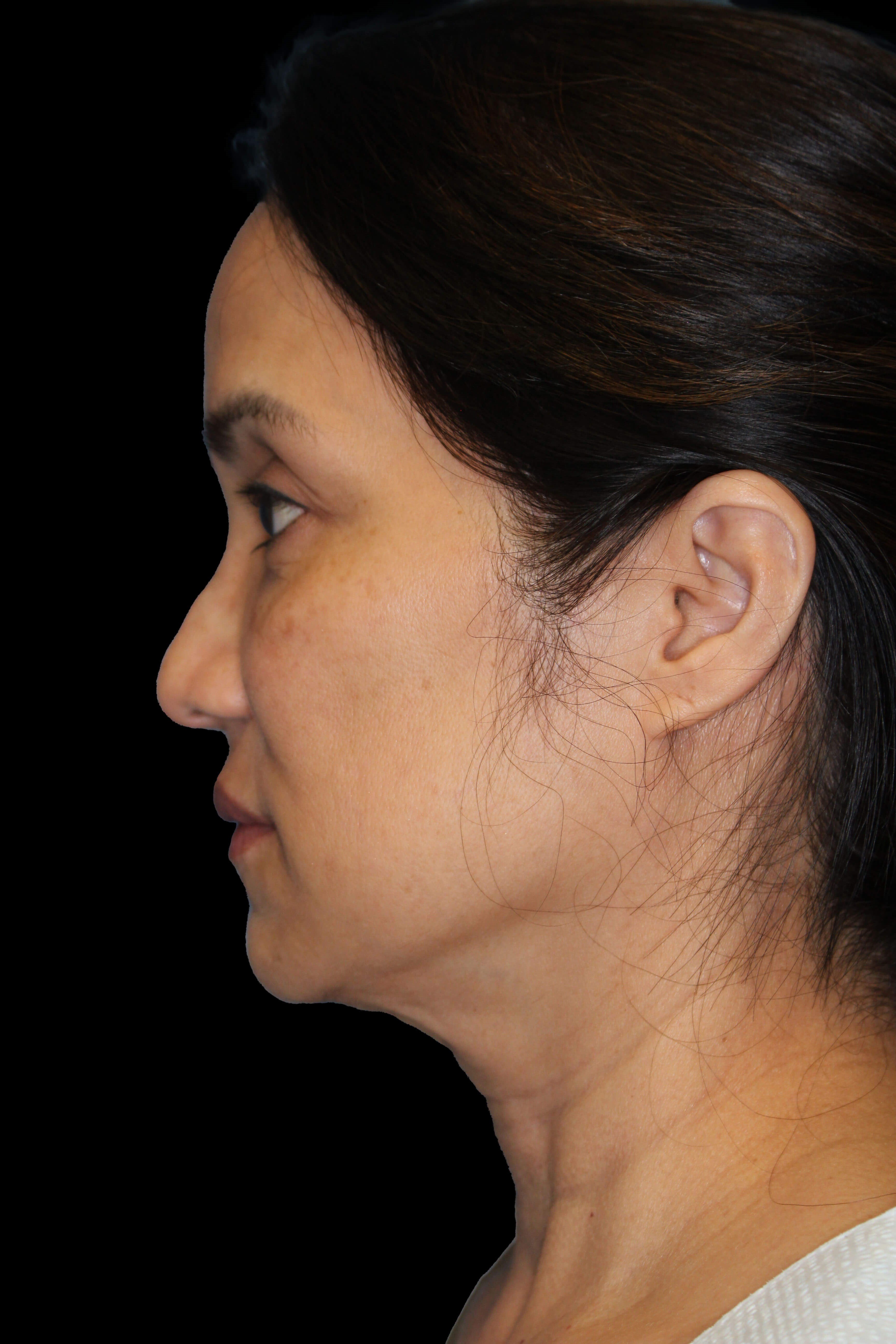 Facelift and Fat Injection Before