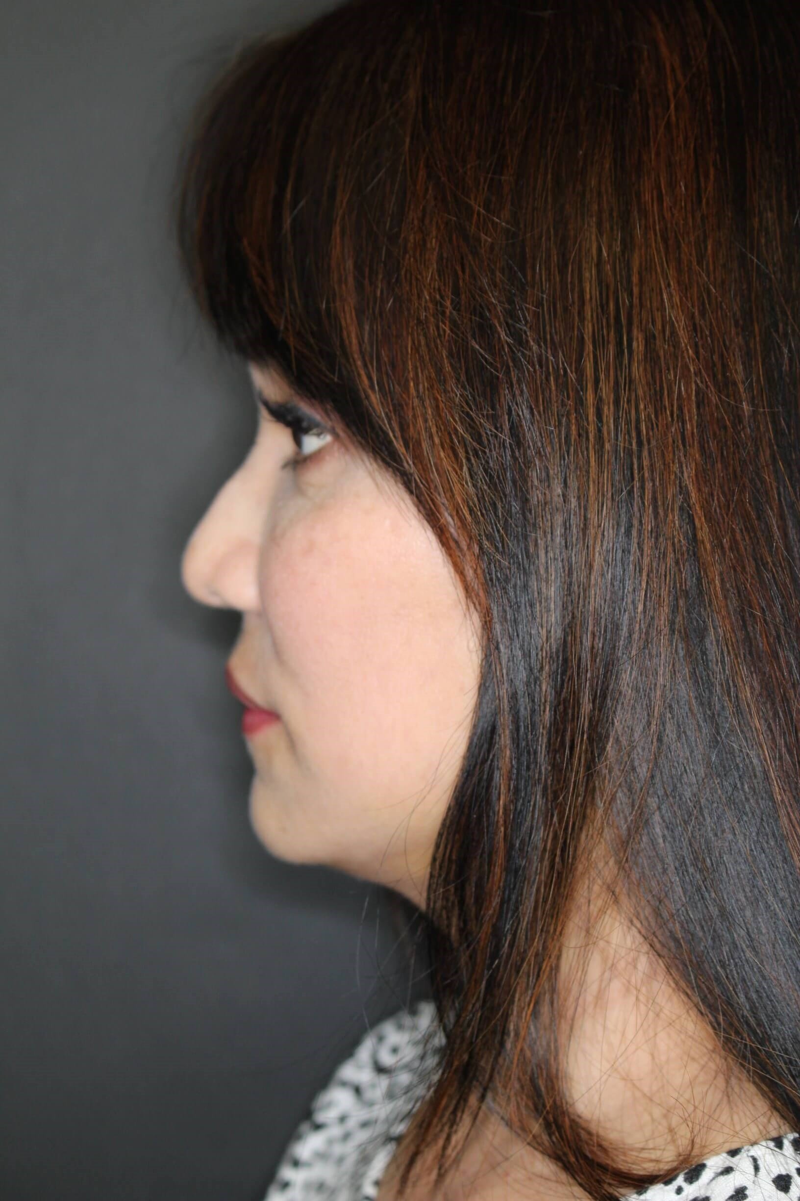 Facelift and Fat Injection After