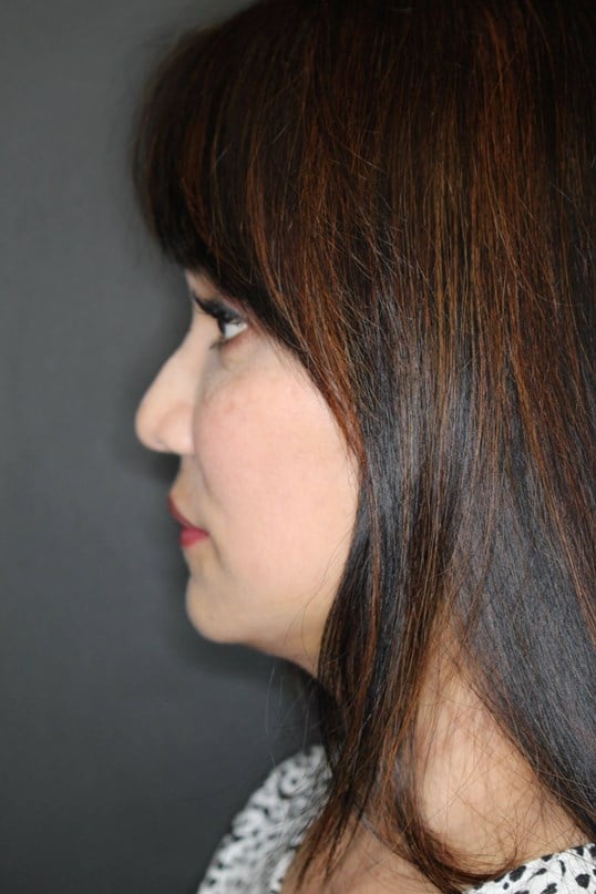 Facelift and Fat Injection After