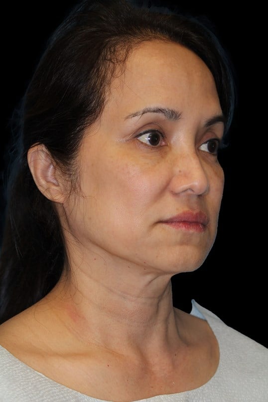 Facelift and Fat Injection Before