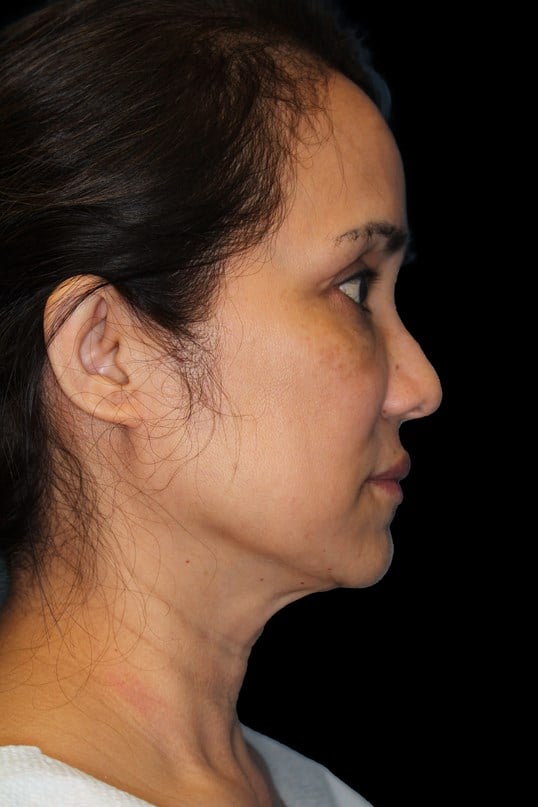 Facelift and Fat Injection Before