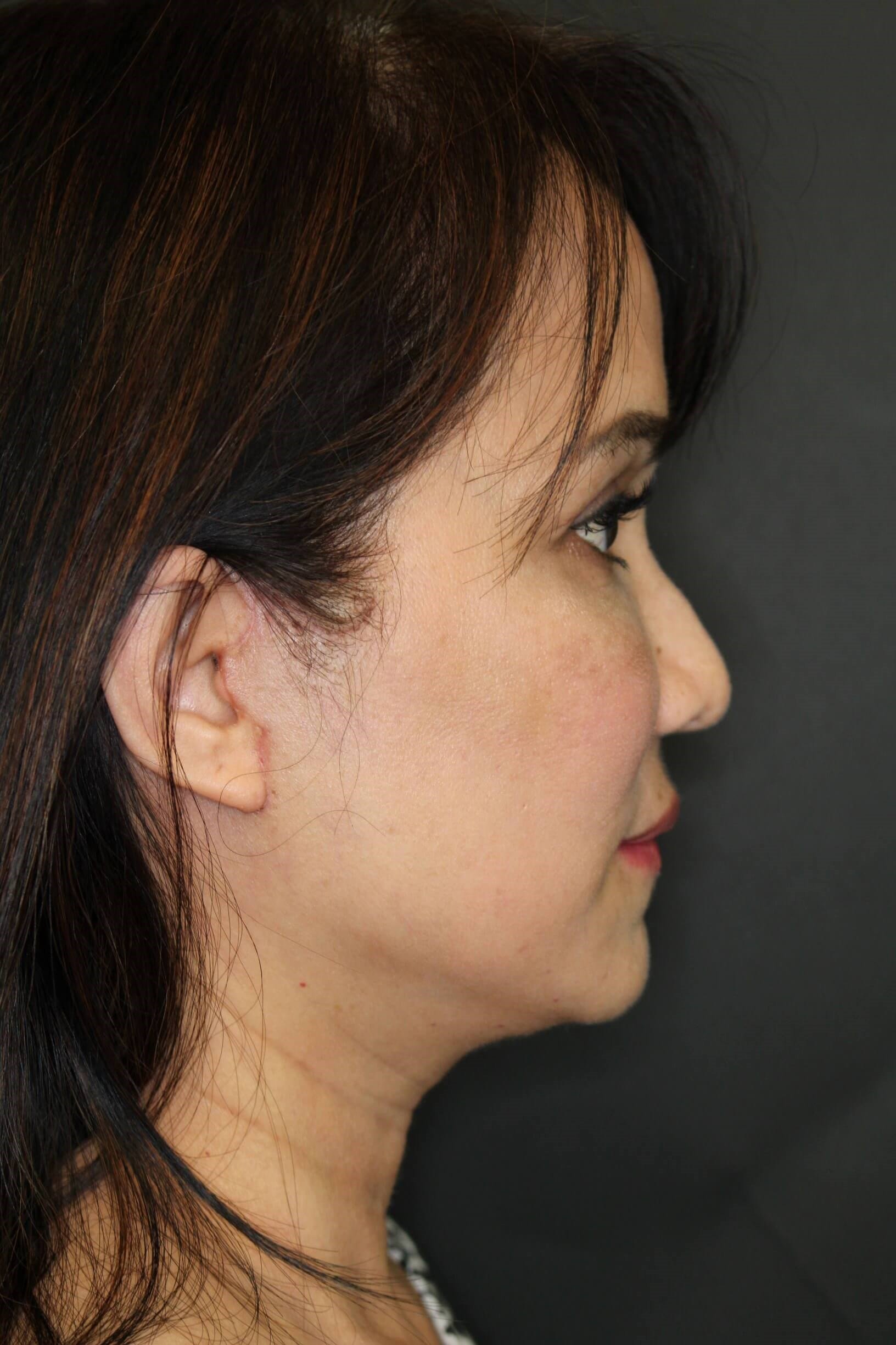 Facelift and Fat Injection After