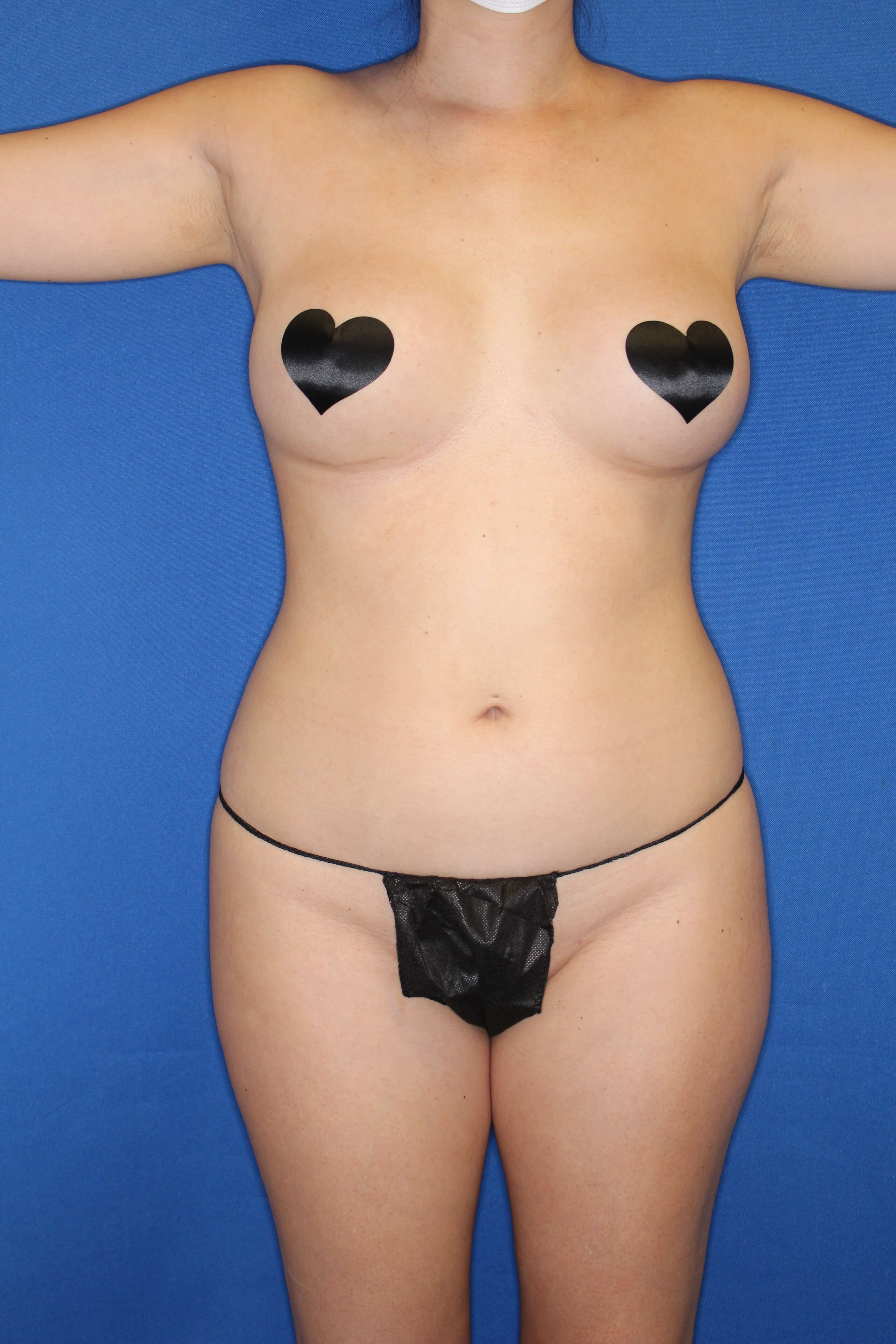 Awake Lipo and BBL Before