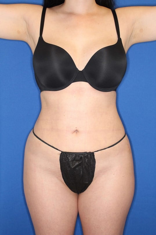 Awake Lipo and BBL After