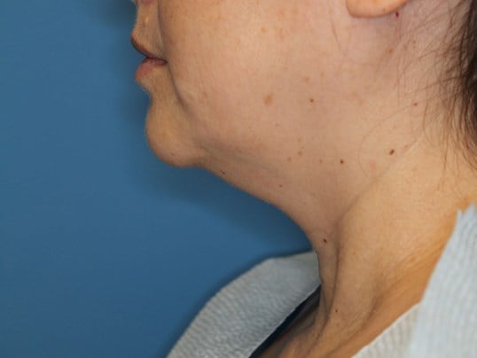 Awake Neck Lipo Before