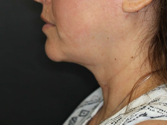 Awake Neck Lipo After