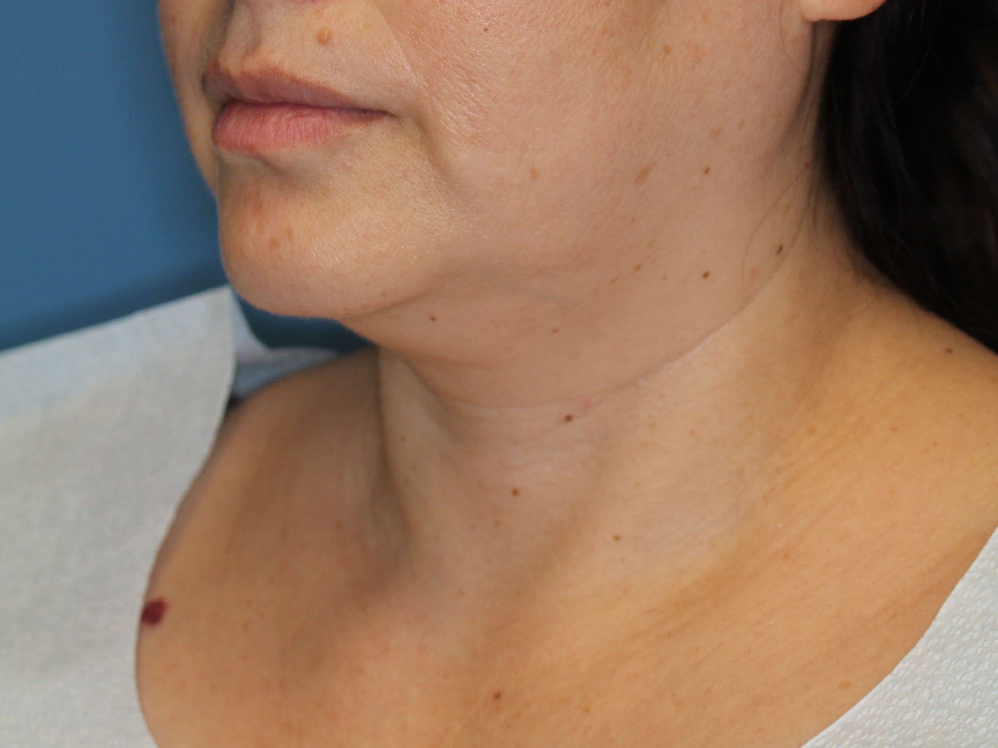 Awake Neck Lipo Before