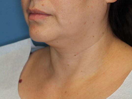 Awake Neck Lipo Before