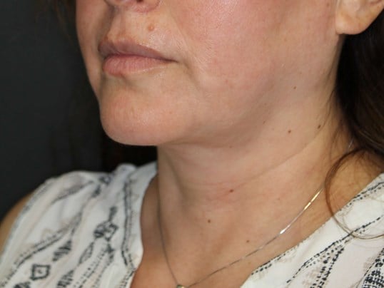 Awake Neck Lipo After