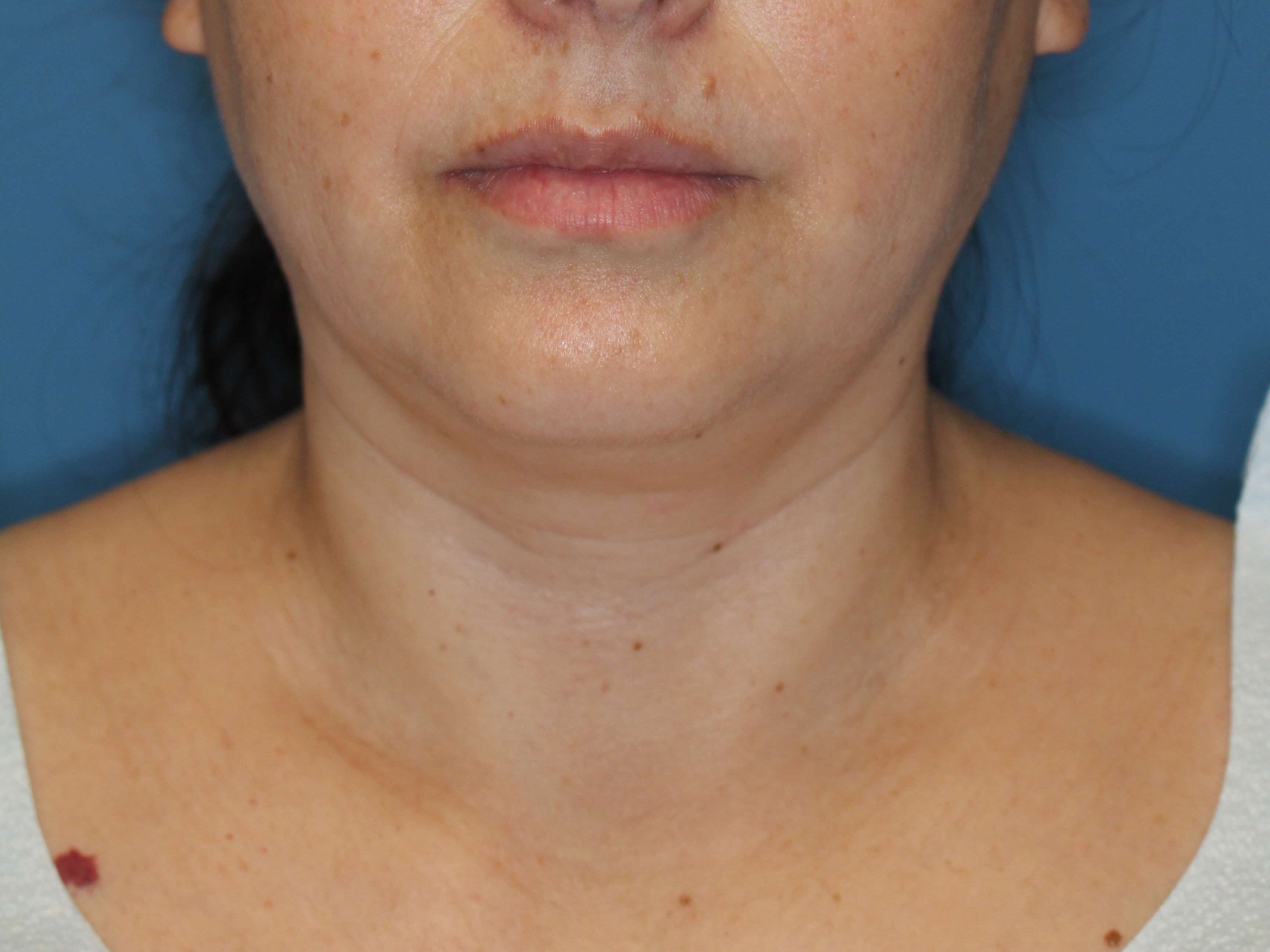 Awake Neck Lipo Before