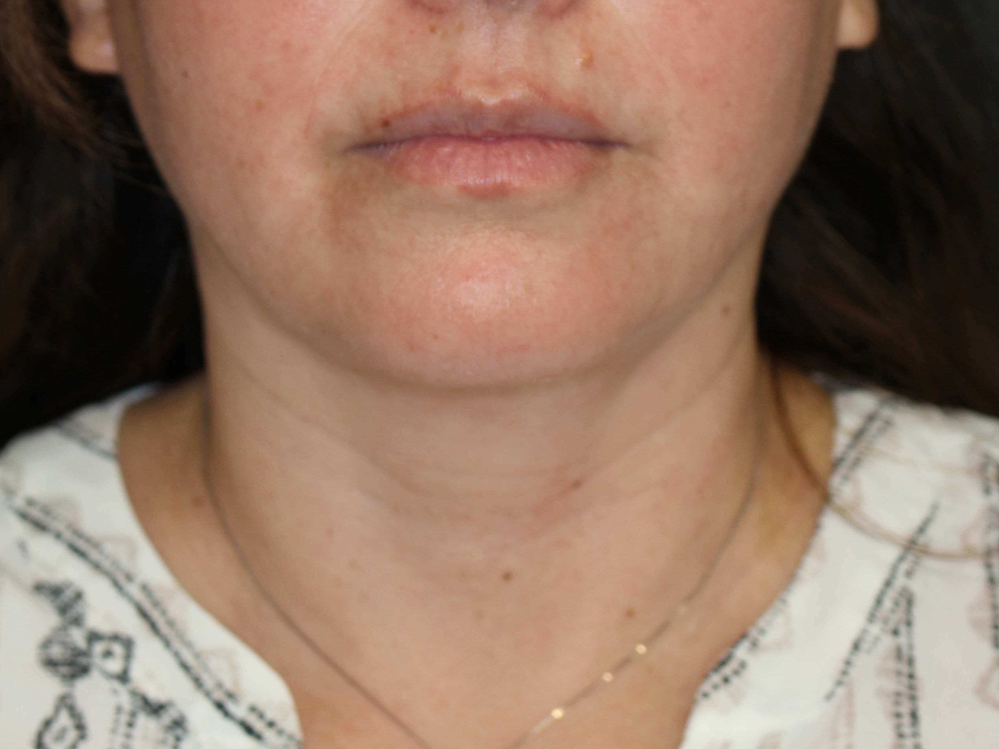 Awake Neck Lipo After