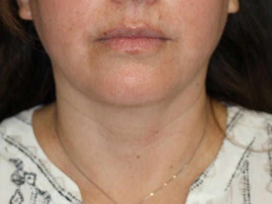 Awake Neck Lipo After