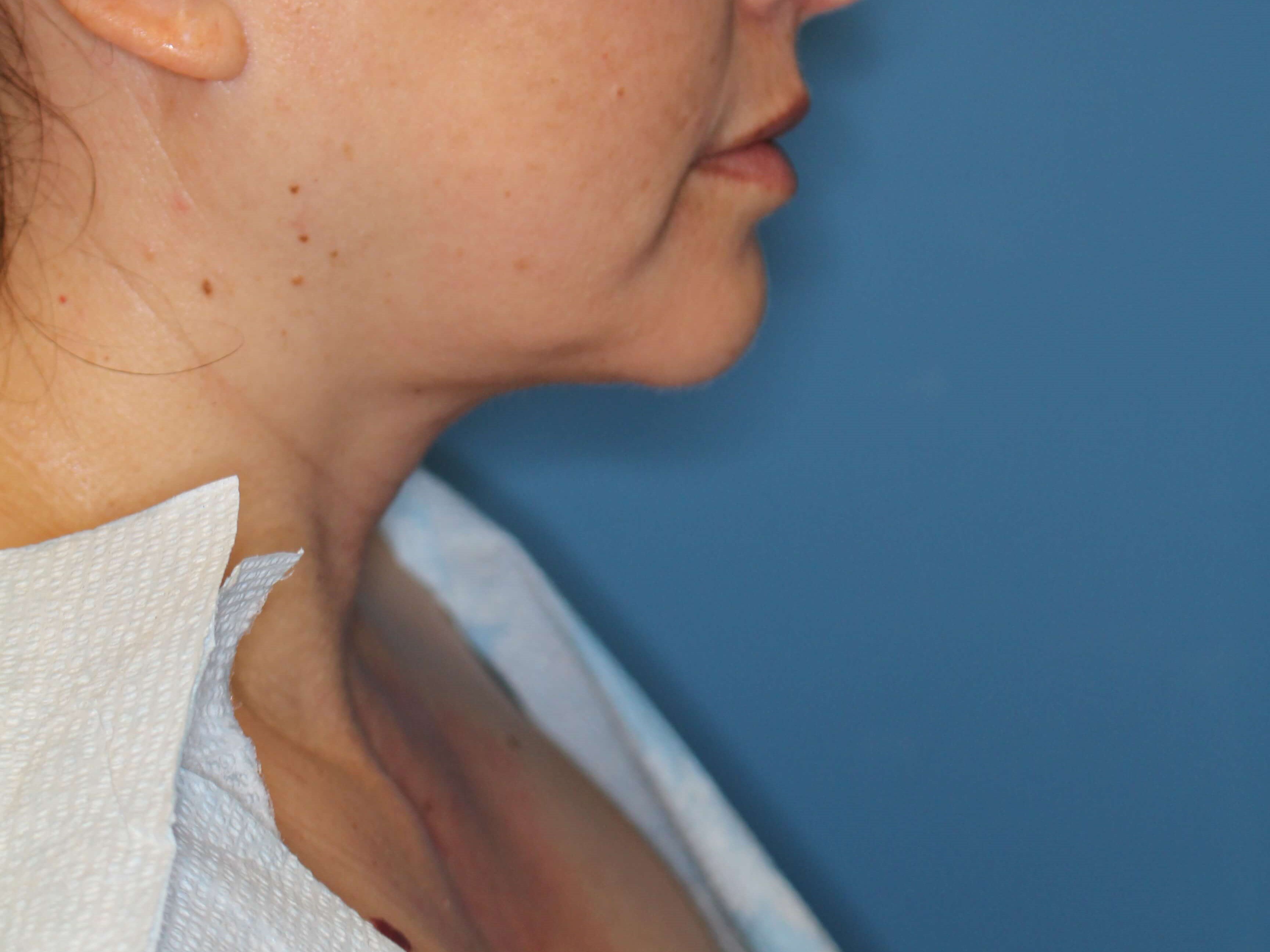 Awake Neck Lipo Before