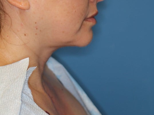 Awake Neck Lipo Before