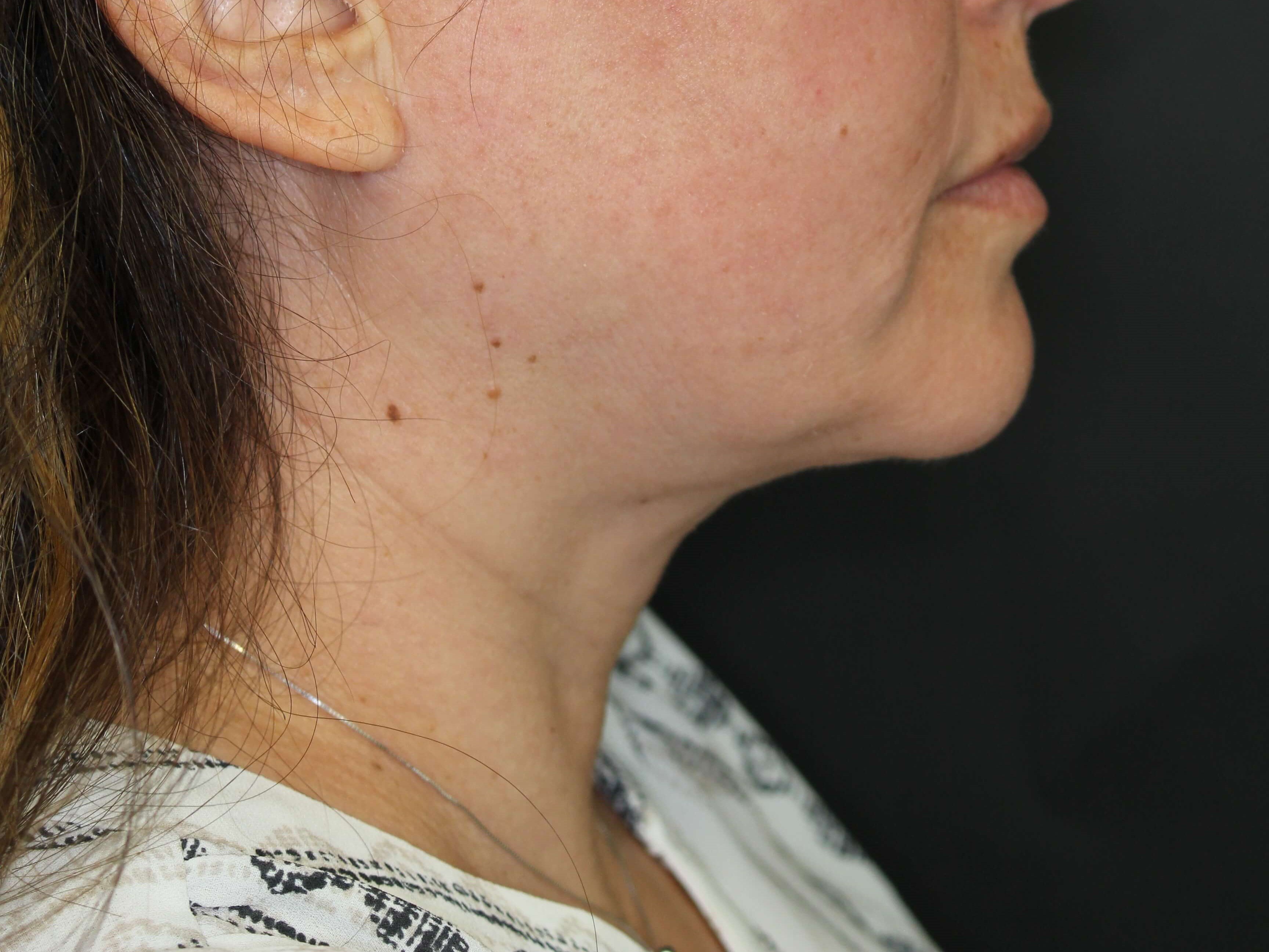 Awake Neck Lipo After