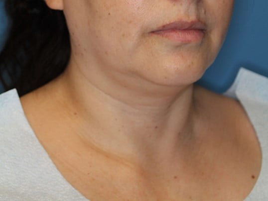 Awake Neck Lipo Before
