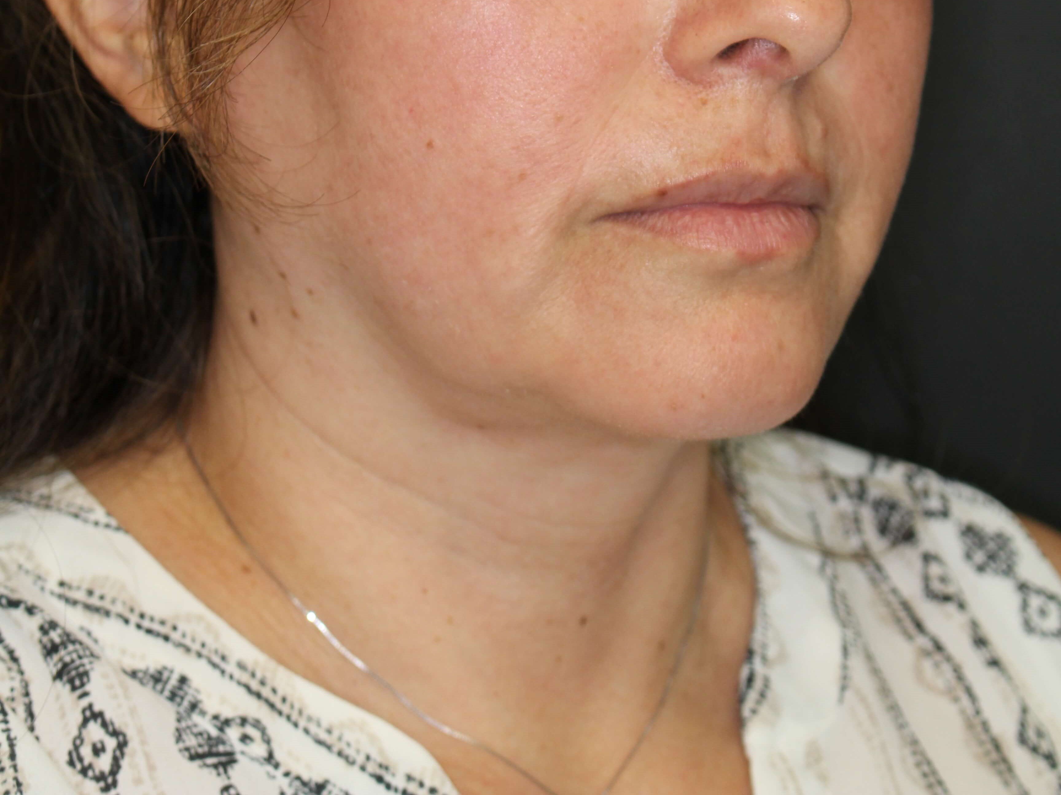 Awake Neck Lipo After