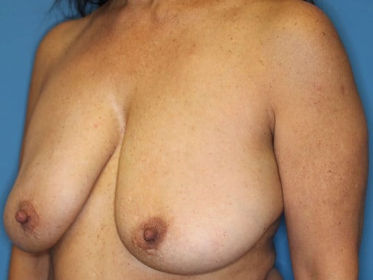 Breast Lift + Silicone Implant Before