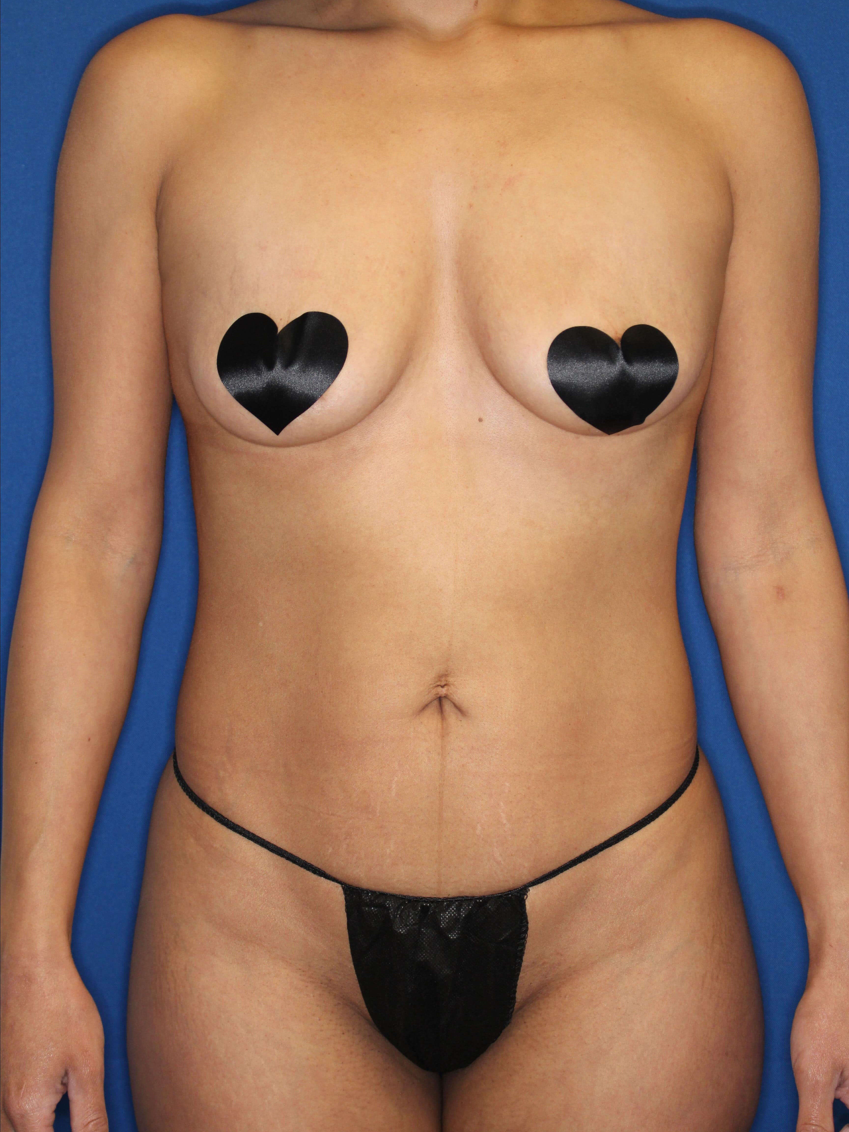 Awake Lipo 360 Before