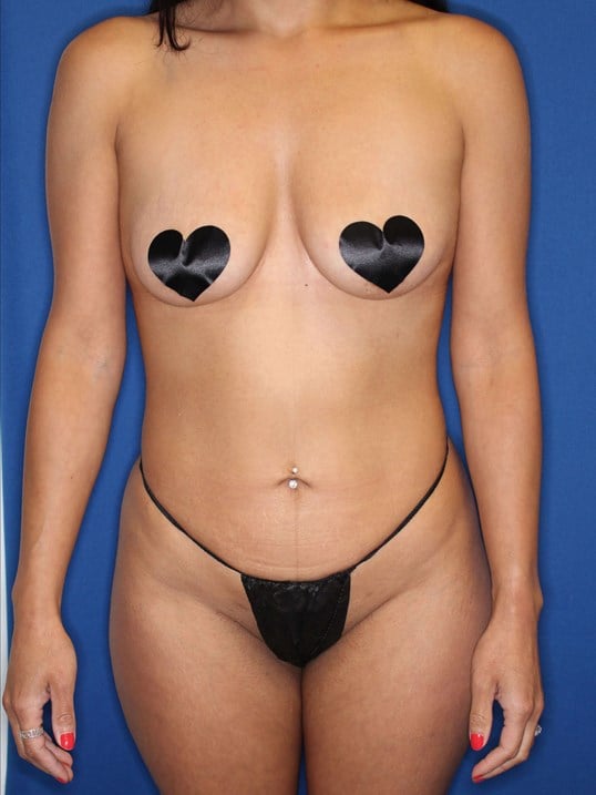 Awake Lipo 360 After