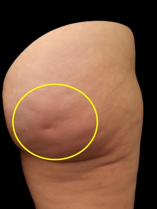 Aveli Cellulite Treatment Before