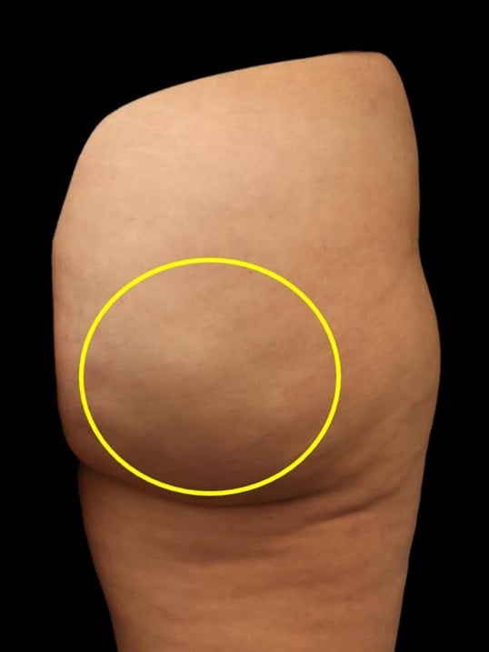 Aveli Cellulite Treatment After