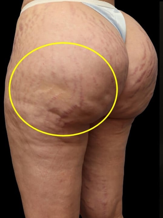 Aveli Cellulite Treatment Before