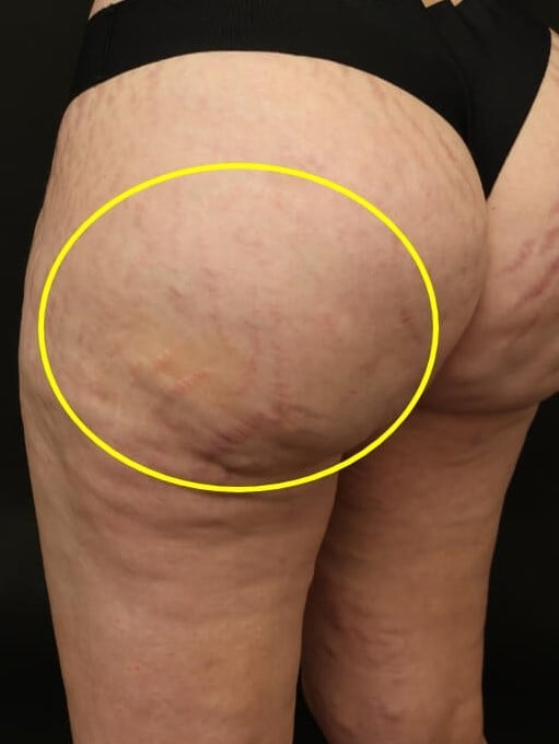 Aveli Cellulite Treatment After
