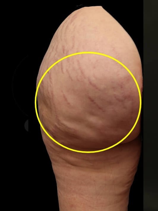 Aveli Cellulite Treatment Before