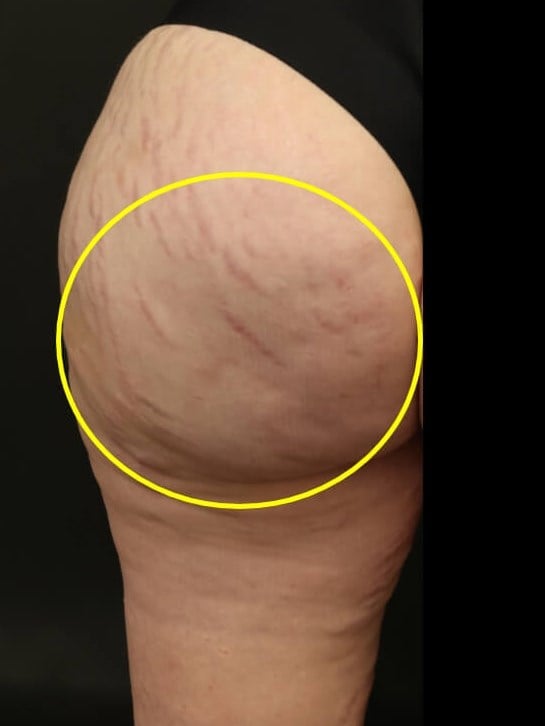 Aveli Cellulite Treatment After