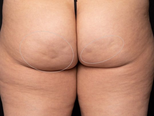 Aveli Cellulite Treatment Before