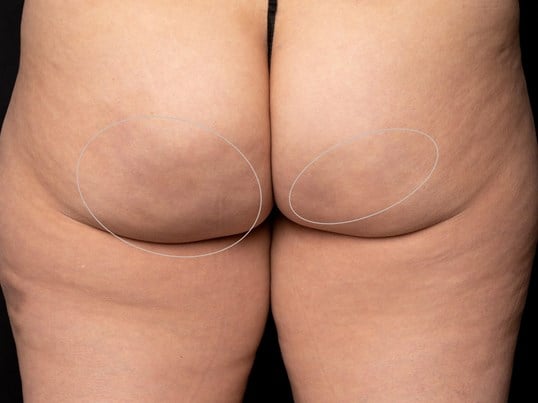 Aveli Cellulite Treatment After