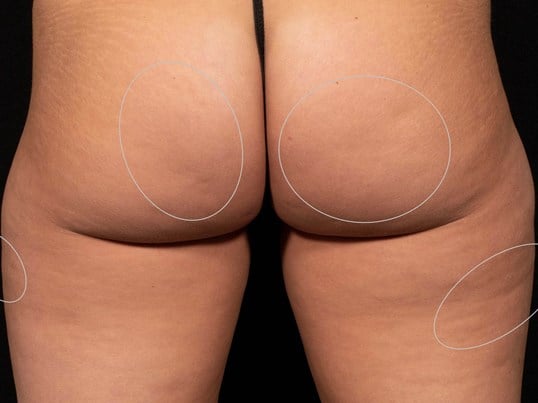 Aveli Cellulite Treatment Before