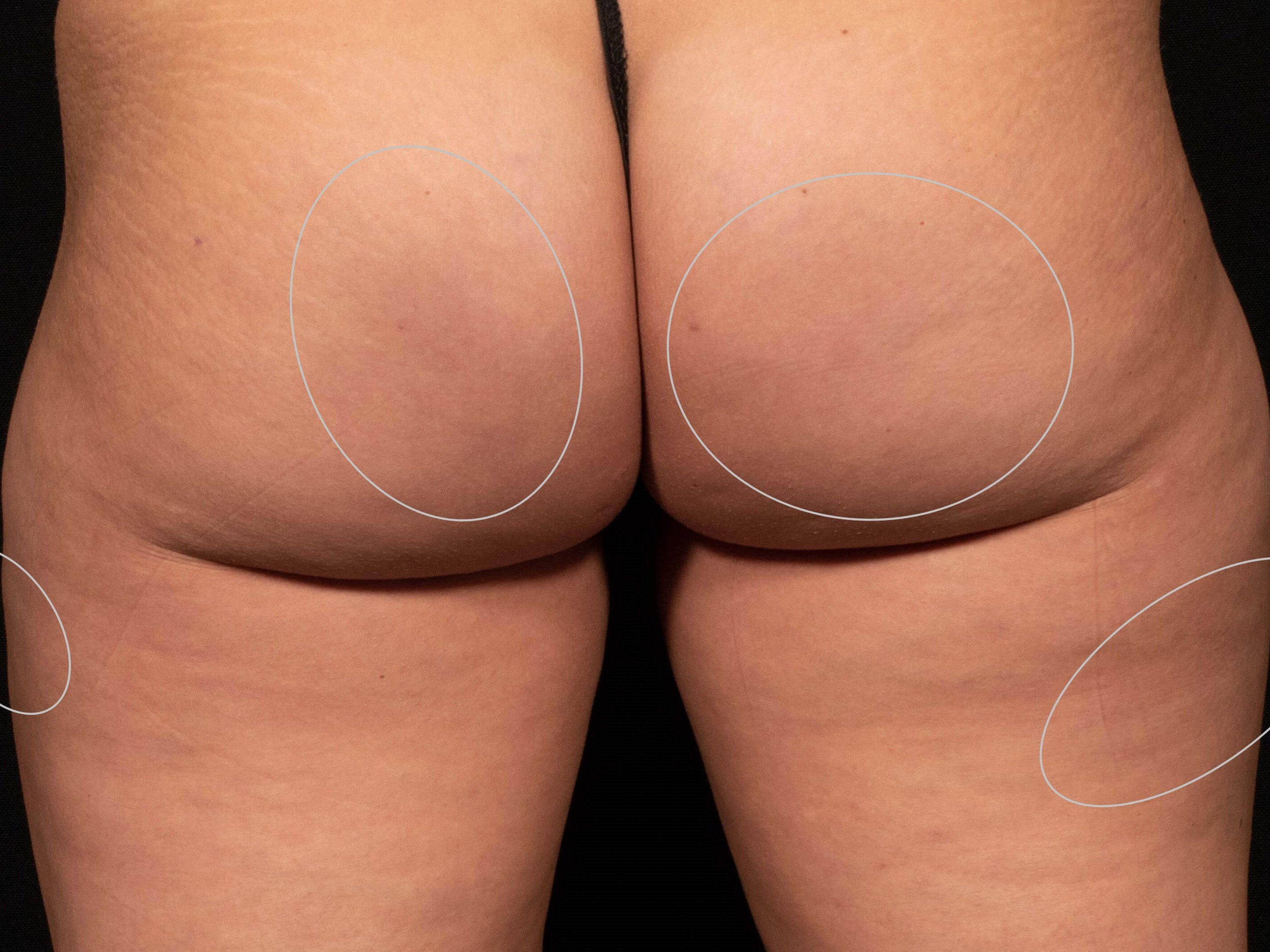 Aveli Cellulite Treatment After